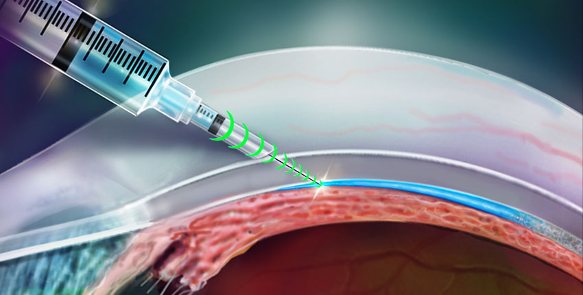 Medtorek's tweet photo. #Investigadores inventan un dispositivo de #inyección de detección de resistencia que sabe dónde ir. #SmartNeedle
Via @harvardmed
📌 https://t.co/TX0bULuCQk
#injection #device
@Ticsemergen @VanessitaDeniz @vic_pallares @rafamanuEl68 @PacientSemergen #NNTTSemergen19 https://t.co/ihntwdEeVf