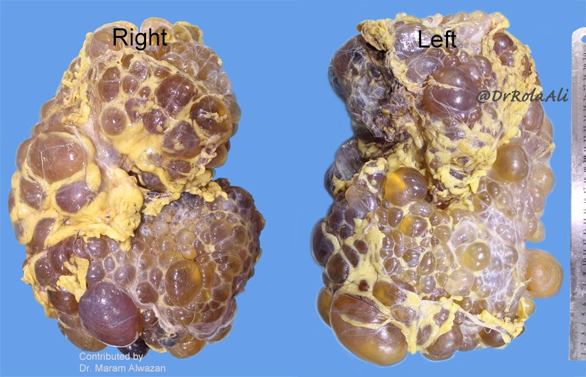 DrRolaAli's tweet photo. Right & left kidneys from the same patient with ADPKD. When symptomatic ADPKD may present with macroscopic hematuria, pain, evident bulge. #pathology #pathologists #gupath #GrossPath #Grossgnosis #macroscopia #renalpath #PathTweetAward https://t.co/ig76CCBKjt
