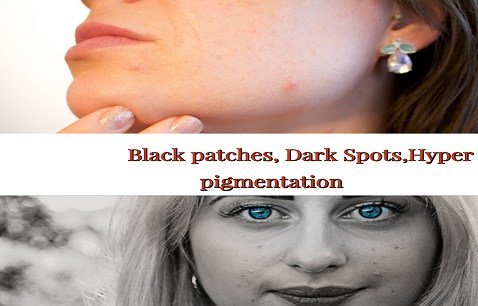 Cystic acne weikiinfo.com/cystic-acne/