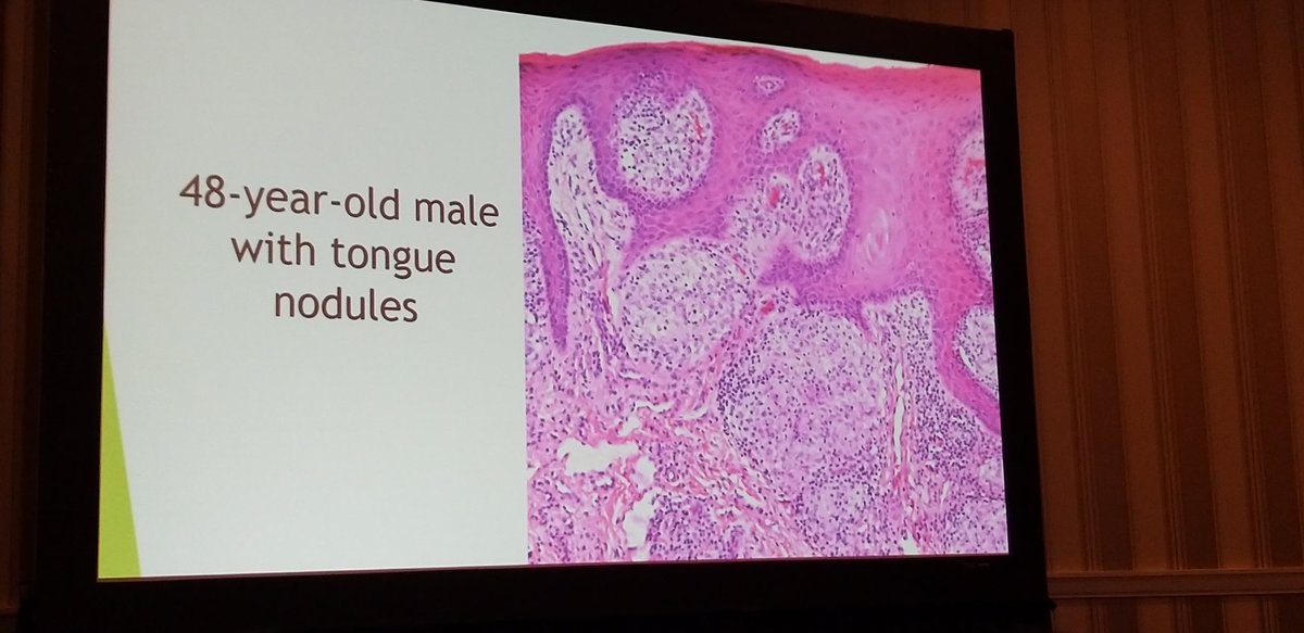 HeadandNeckPath's tweet photo. Granulomas with Susan Muller at the NASHNP meeting #USCAP #NASHNP #Headandneckpath https://t.co/Vn42s7vWiA