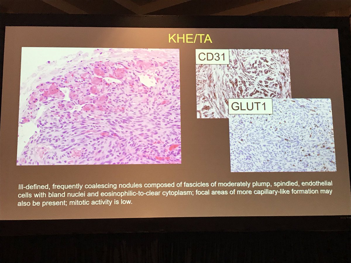 Kaposiform hemangioendothelioma &amp; tufted angioma are likely the same thing. Just different names based on size/depth. -Paula North. #USCAP2019 #ISBSTP #pathology #BSTpath #dermpath #dermatology #pedipath