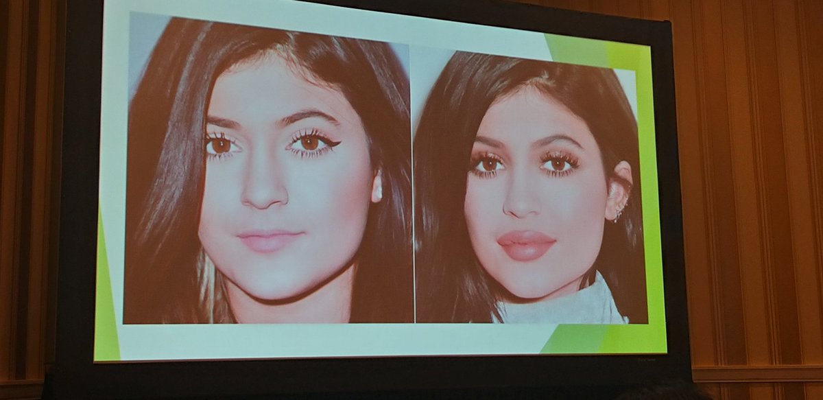HeadandNeckPath's tweet photo. Fillers by Susan Muller at the NASHNP meeting #USCAP #NASHNP #Headandneckpath https://t.co/FK6mYi9Gqa