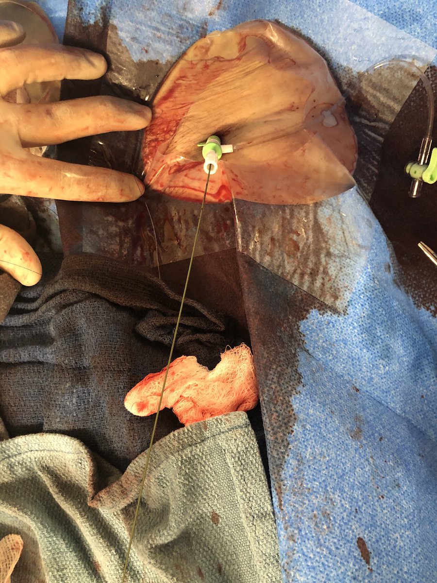 RajTayalMD's tweet image. Cross over balloon occlusion technique (COBT) sig reduces bleeding complications in large bore access. This is my modified #ipsilateral #BOT using 8x40 balloon inflated thru the LBA to reduce to 6Fr on 0.035 wire. Had 1 Pre-close finished with #hybridclosure using 6Fr Angioseal