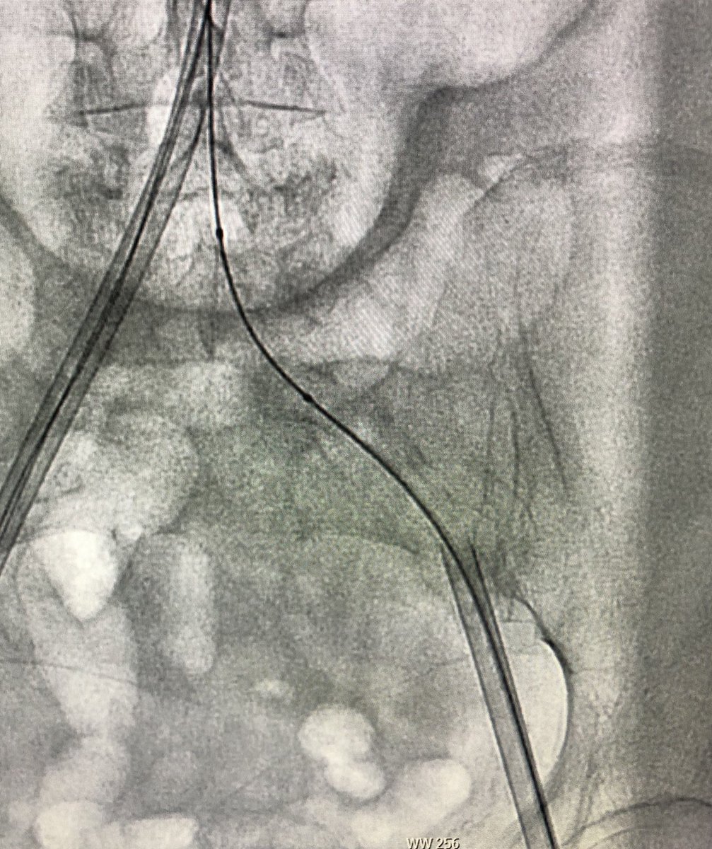RajTayalMD's tweet image. Cross over balloon occlusion technique (COBT) sig reduces bleeding complications in large bore access. This is my modified #ipsilateral #BOT using 8x40 balloon inflated thru the LBA to reduce to 6Fr on 0.035 wire. Had 1 Pre-close finished with #hybridclosure using 6Fr Angioseal