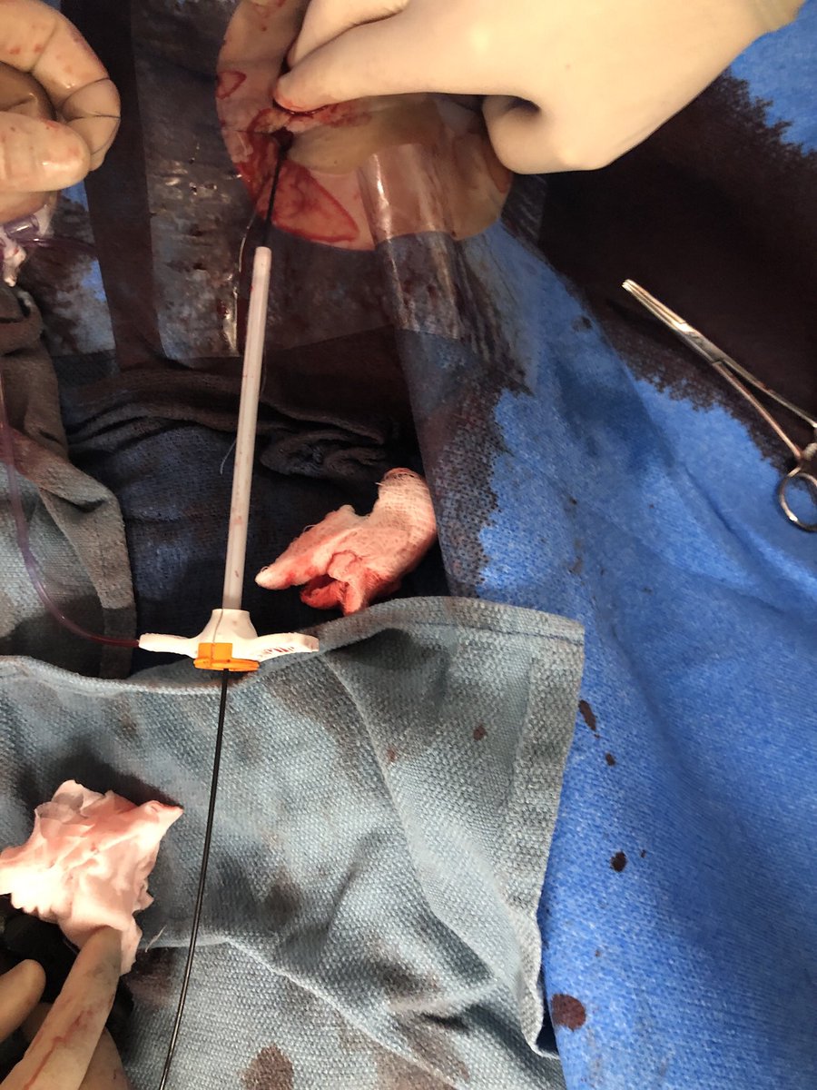 RajTayalMD's tweet image. Cross over balloon occlusion technique (COBT) sig reduces bleeding complications in large bore access. This is my modified #ipsilateral #BOT using 8x40 balloon inflated thru the LBA to reduce to 6Fr on 0.035 wire. Had 1 Pre-close finished with #hybridclosure using 6Fr Angioseal