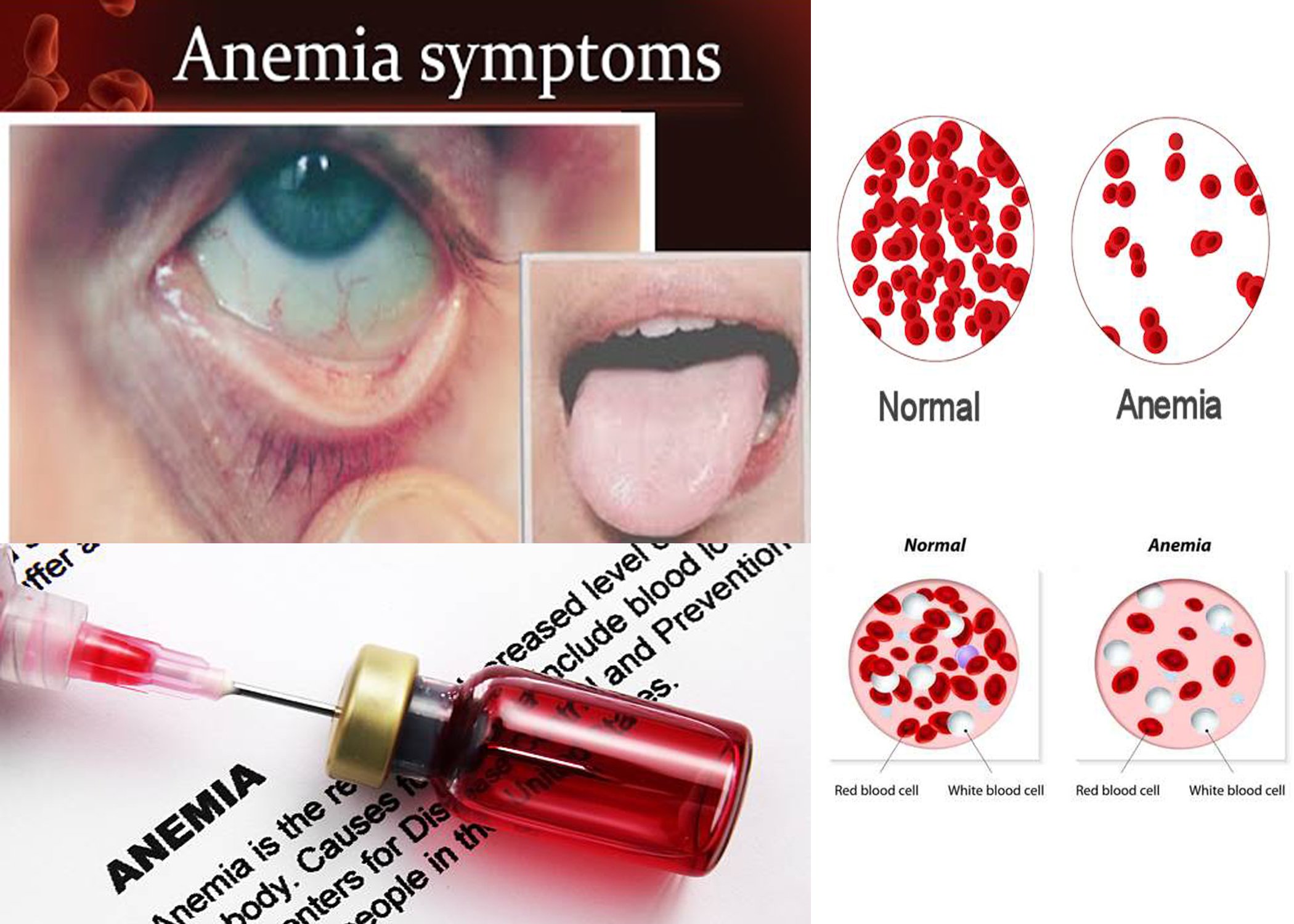 Anemia y cetosis