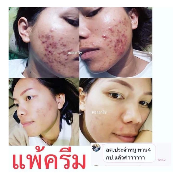 parinda18377655's tweet photo. 📍 สูตร 2 ➕ 1 💜🧡. ใครๆได้ลองก็ติดใจ
‘ 📍 #ลดสิว #ผิวขาว ทานคู่กันเห็นผลไว 2 เท่า🤟🏼
❌ ไม่มีส่วนผสมของกลูต้า นะจ๊ะ ❌
🔖 คู่นี้ 540฿ ส่งฟรี EMS.
♡⠀สั่งซื้อคลิ๊ก
🆔 LINE : https://t.co/0QcjbU4I5W
📫INBOX มาได้ตลอด 24 ชม. เลยค่ะ
📱 Tel.:: 080-767 8969
#COLLPLUS #ZOMRICHZU https://t.co/Fyy0b2RuyZ