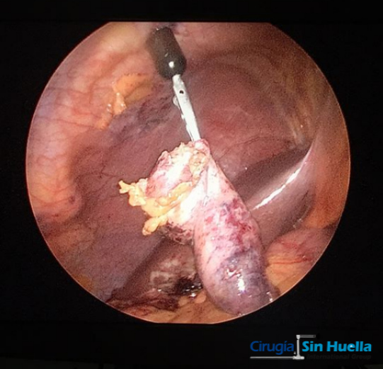 sinhuella's tweet photo. Extracción de #vesicula biliar por #colecistitis
Una sola incisión umbilical, menor dolor y rápida recuperación...
#cirugiasinhuella #cirugiaconimanes #imanlap #magnetsurgery https://t.co/UwWiZcpBm3