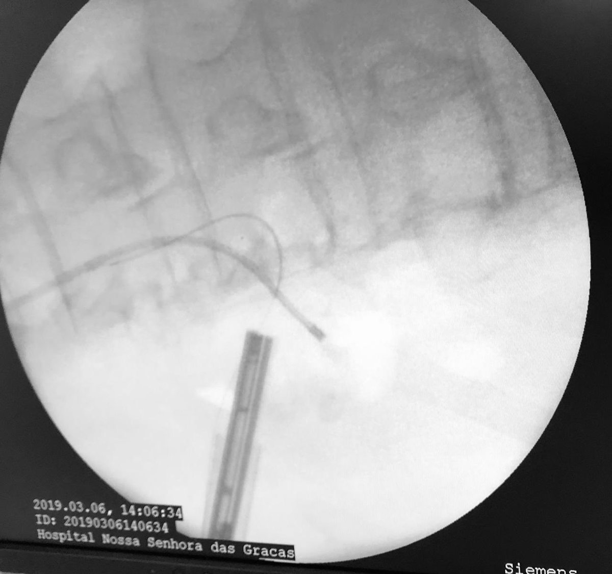 Dr Thiago Hota (@thiago_hota) on Twitter photo 65 yo patient, staghorn calculi, others caliceal stones, chronic kidney disease and complex renal cyst. To prevent multiple punctures, performed #ECIRS, just 1 puncture was enough to achieve stone free status. @CesarMierzwa <a href="/slongo_luiz/">Luiz Edison Slongo</a> <a href="/alexoschneider/">Alex Schneider</a> <a href="/scoffonecesare/">scoffone cesare</a> 65 yo patient, staghorn calculi, others caliceal stones, chronic kidney disease and complex renal cyst. To prevent multiple punctures, performed #ECIRS, just 1 puncture was enough to achieve stone free status. @CesarMierzwa <a href="/slongo_luiz/">Luiz Edison Slongo</a> <a href="/alexoschneider/">Alex Schneider</a> <a href="/scoffonecesare/">scoffone cesare</a>