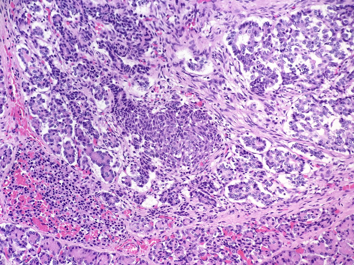 HenryTranMD's tweet photo. Incidentally found this guy sitting in the middle of the pancreas. Patient was a term infant.
The following IHC stains will be CK5/6 and CK8/18. 
#pedipath #pathology #PathBoards #tumor #pancreas https://t.co/GRx4jvBaQF