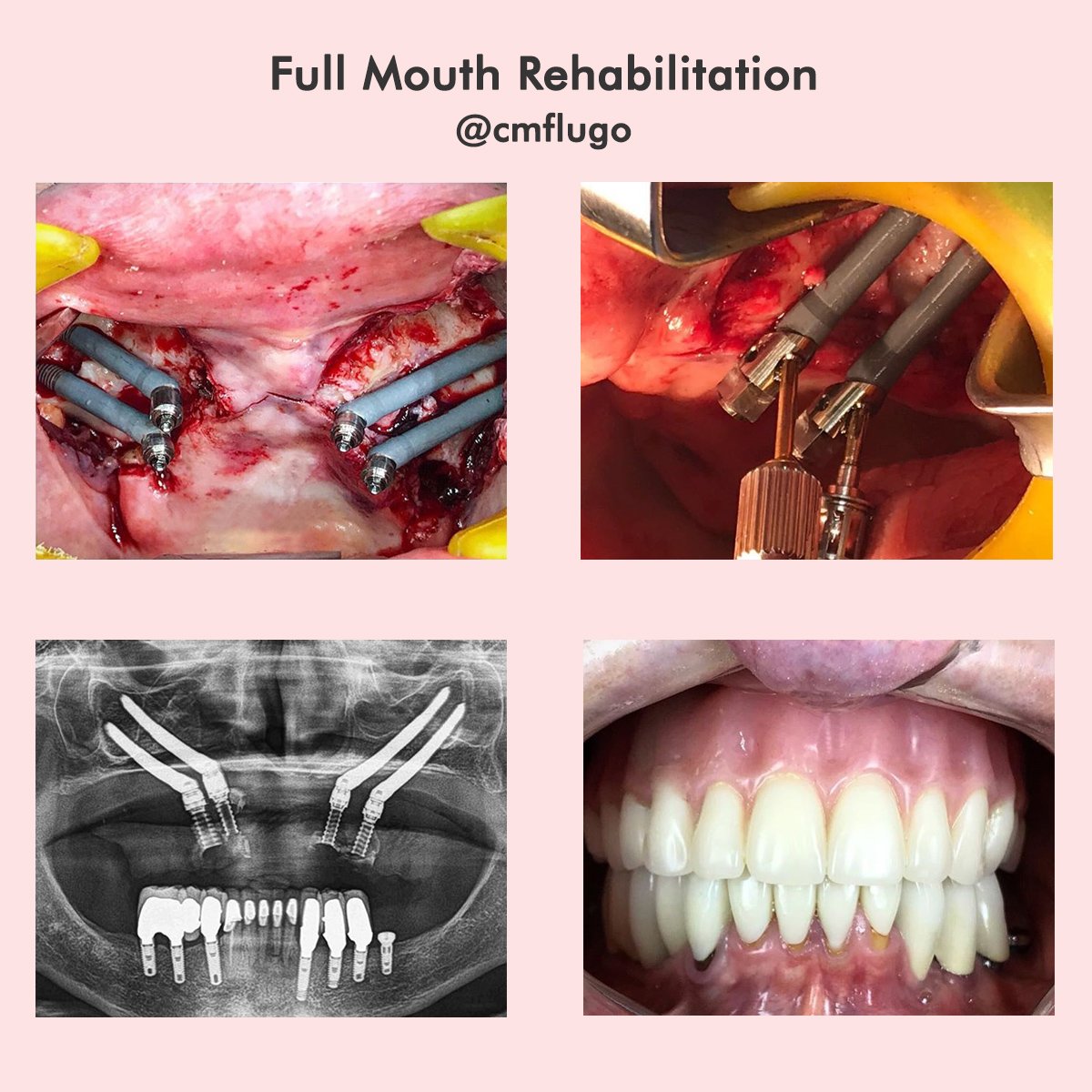 This is the process of a Full Mouth Rehabilitation. Do you know it? #fullmouthreconstruction #dentalimplants #maxillofacialsurgeon