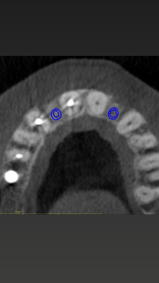 Virtual workup of Straumann 2.9 Implant case in West TX! Only 5mm of space needed for this implant!  #straumann #strongerthanyoursmallimplant #oralsurgery #periodontics #dentalimplants #codiagnostix