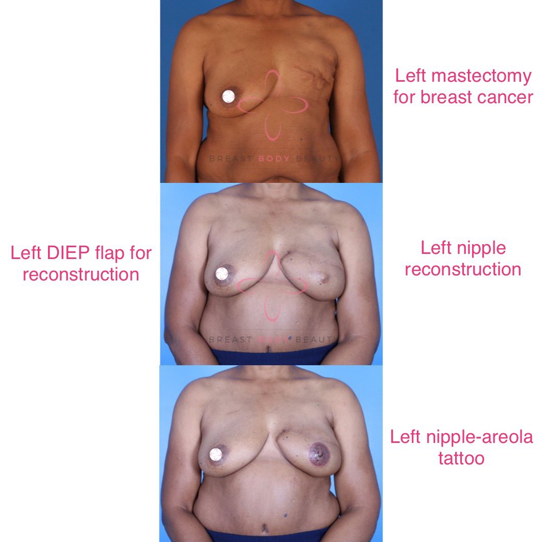BreastnBodyDoc's tweet photo. #WCW ππΎ loved completing this #breastcancer survivorβs #NaturalButNoticeable recon! I used her abdominal skin/fat #DIEPFlap to reconstruct her breast & medical grade tattooing to create a natural appearing areola.
#PlasticSurgery #BreastReconstruction #Atlanta #ILookLikeASurgeon https://t.co/MXTPcyjtSp