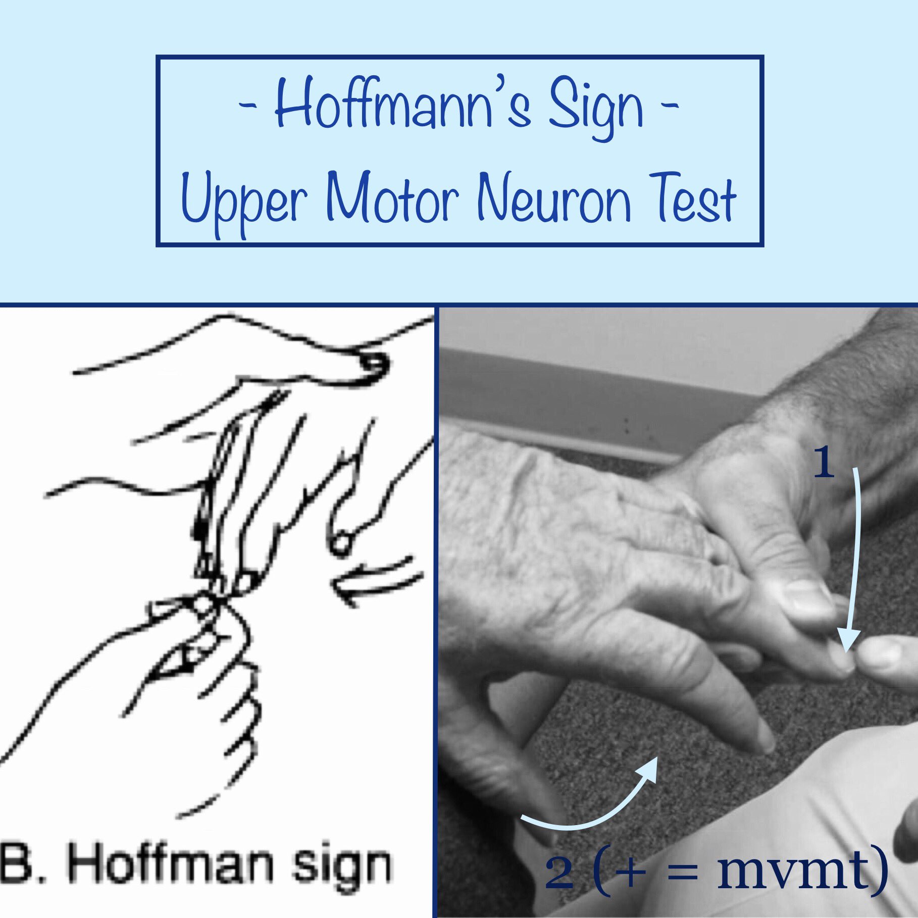 Lil Bone Peep Hoffmann S Sign Upper Motor Neuron Test Perform By Flicking Or Tapping The Nail While Relaxed Sign If The Thumb Index Finger Reflexively Adduct Flex
