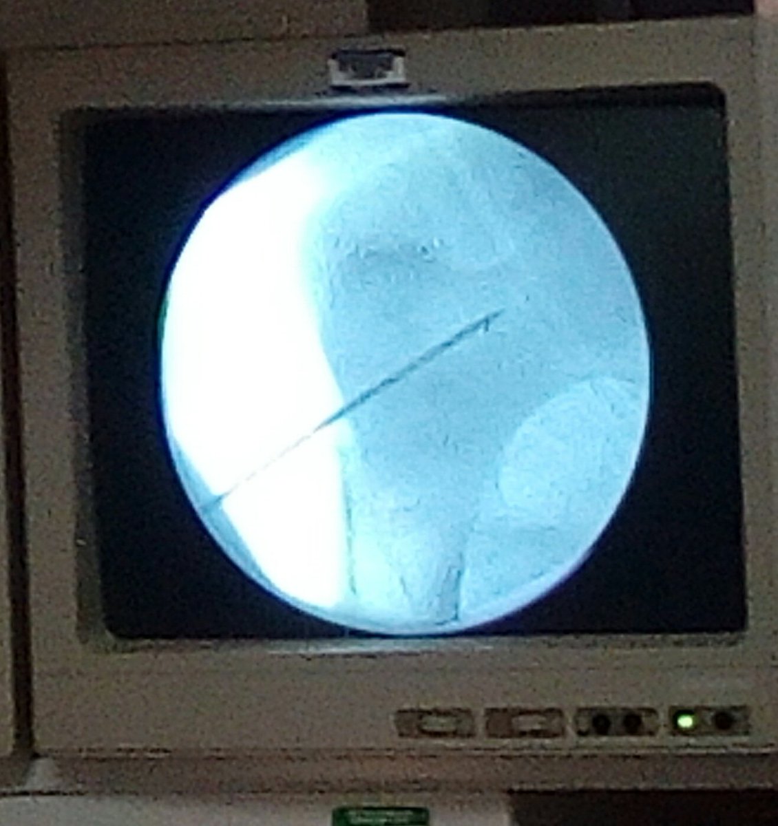 DanielLechigue1's tweet photo. I observed a second operation on the 4th day of the internship. After watching a Kidney removal yesterday, I experienced a femur drilling operation. The image is the X-RAY of the femur with a drill going through.
#ICSIntern19 @SihamCAS @ICSAddis https://t.co/oasEgKHJl4