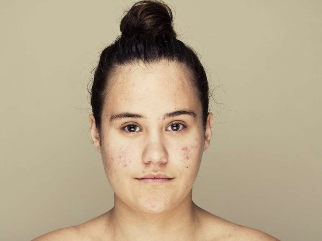 AirsConference's tweet photo. Many people don't consider the skin #microbiome when applying creams and other cosmetic products. Here's how one common anti-acne drug alters our skin microbiome. During our conference we will address many similar topics.
https://t.co/RYdL73CqLD
#AIRSConference #skincare https://t.co/0H8l0KVxpd