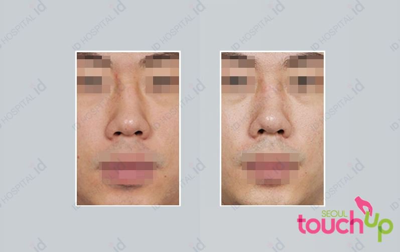 SeoulTouchUp's tweet photo. Check out this before and after photos from one of our patients.

https://t.co/2bVYQSEMSP

#seoultouchup #seoultouchup_reviews #rhinoplasty #nosejob #plasticsurgeryinkorea #plasticsurgeryresults #plasticsurgeryreviews  #koreanplasticsurgery #nosesurgery #beautifulnose https://t.co/P44Ipo5AQM
