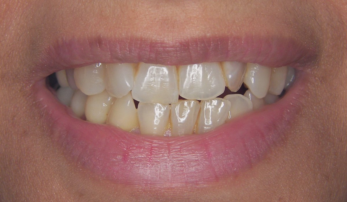 After they've carried burdens this year, this case comes to pat on my shoulders... ❤️

Crowns #16,15,14 &amp; 22
Veneers #13-23 
External bleaching for #24,25 &amp; #35-45

Thanks to Dr.Yuosra Aljazairy &amp; Dr.Sharifa AlShahri
For there closed supervision

#493DEN 
الحمد لله ✨