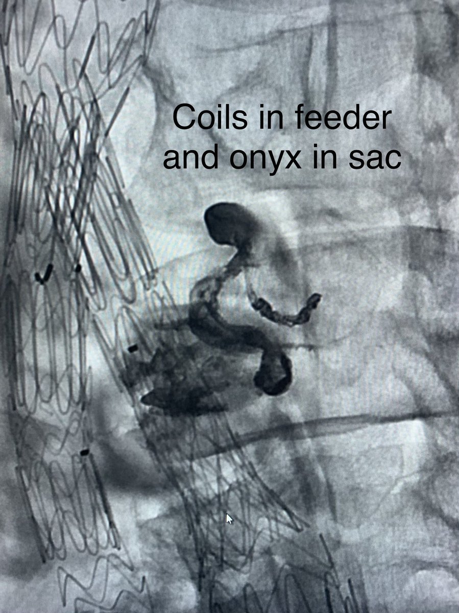 KMSchramm's tweet photo. Space of Kazimirko (def.): Retroperitoneal fat plane between the IVC and vertebra that @dnkazimirko doesnt think can be accessed to avoid caval puncture during type II endoleak repair w/ direct sac puncture. @SiemensHealth iGuide, coils, and Onyx FTW. #tightsqueeze #irad #miips https://t.co/GEG3oTfDT0