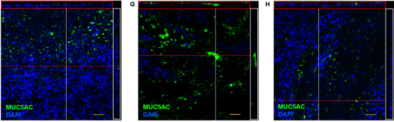 pulmonary_news's tweet photo. Researchers from @Providence_Hlth & @UBCGradSchool found that receptor patched homolog 1 provides a novel target to reduce chronic bronchitis in chronic obstructive #pulmonary disease patients. https://t.co/ZPWw0LKOrr https://t.co/ti8yinUsxa