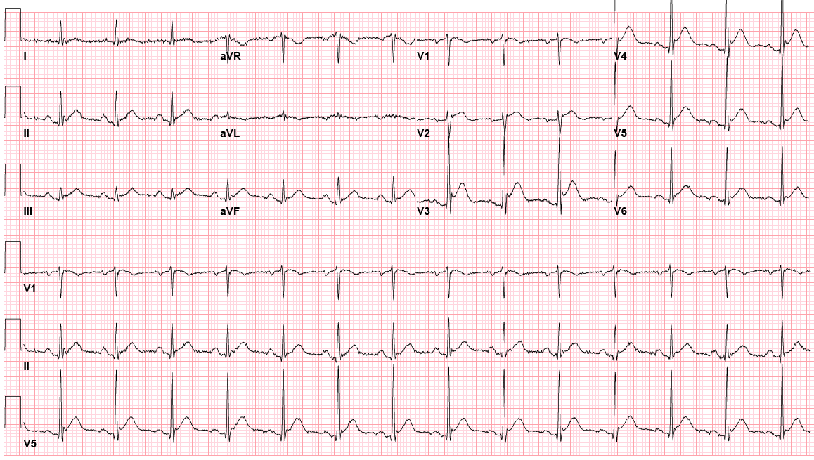 Interesting case: called to a rapid response for neck &amp; chest pain in 63yo M with hx of SCC of tongue now 3 months post-glossectomy &amp; laryngectomy. Initial vitals stable. EKG below - previous EKG with TWI in aVL. Do you activate STEMI team? What are your next steps? #FOAMed #EKG