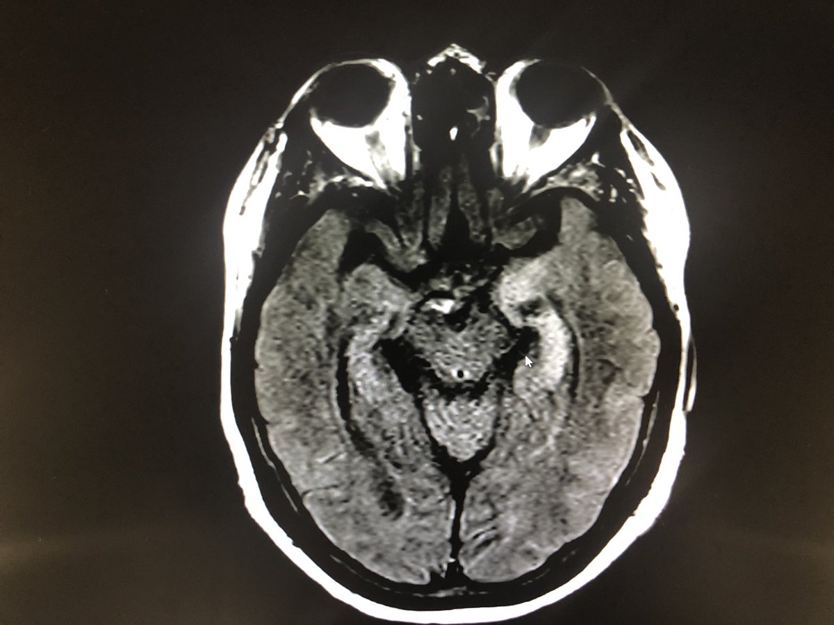 garinho29's tweet image. About a patient of mine with #LimbicEncephalitis whose onset was with a partial status 😁 #NeuroChallenge