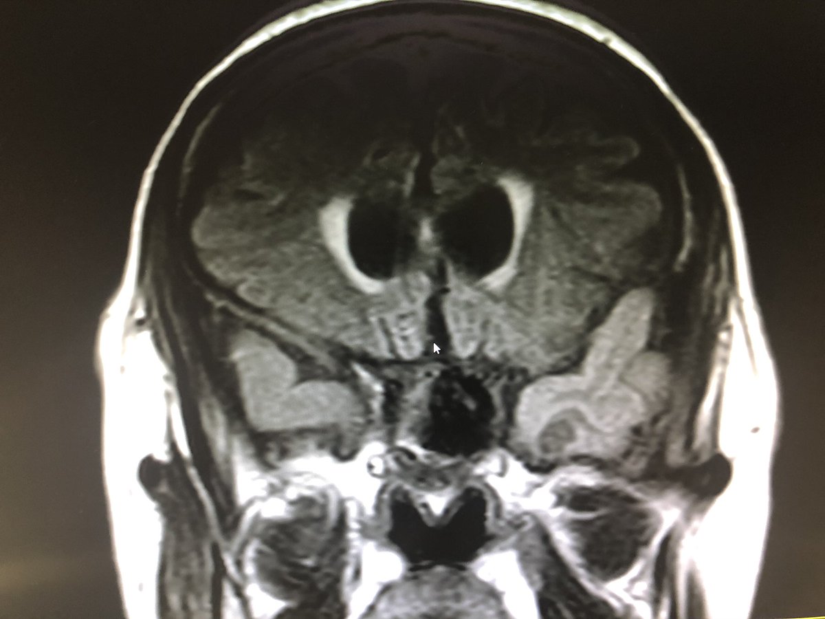 garinho29's tweet image. About a patient of mine with #LimbicEncephalitis whose onset was with a partial status 😁 #NeuroChallenge