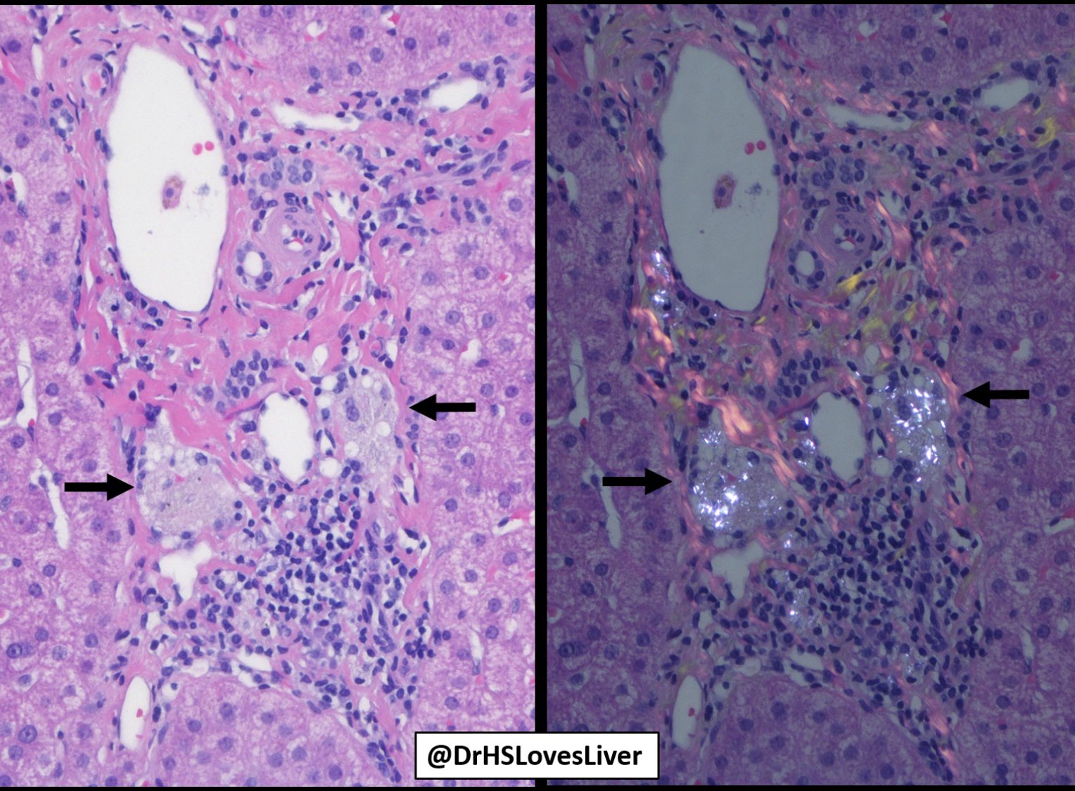 Heather L Stevenson Md Phd On Twitter With The Opioid Epidemic In Our Country And The Unfortunate Rise In Hcv Infections We May Be Seeing More Of These In Liver Biopsies If