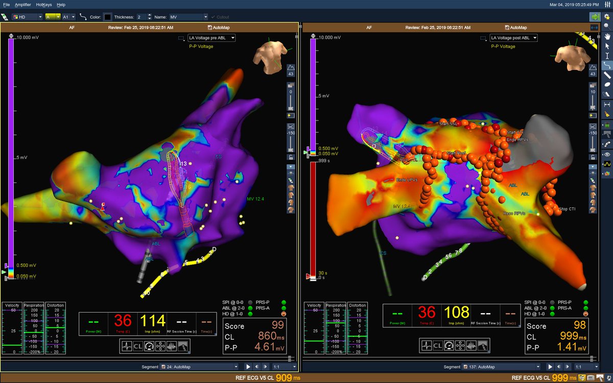 MicheleB_MD's tweet photo. #HDGrid100 - (our) standard Treatment for #PersistentAFib. Some of us believe that PVAI might be enough. I prefer to add lines trough the substrate (rather than CFAEs or "scar" ablation). Lines have an achievable end point: bidirectional block. Thoughts? #EnsitePrecision #EPeeps https://t.co/RtpaQVQ9lj