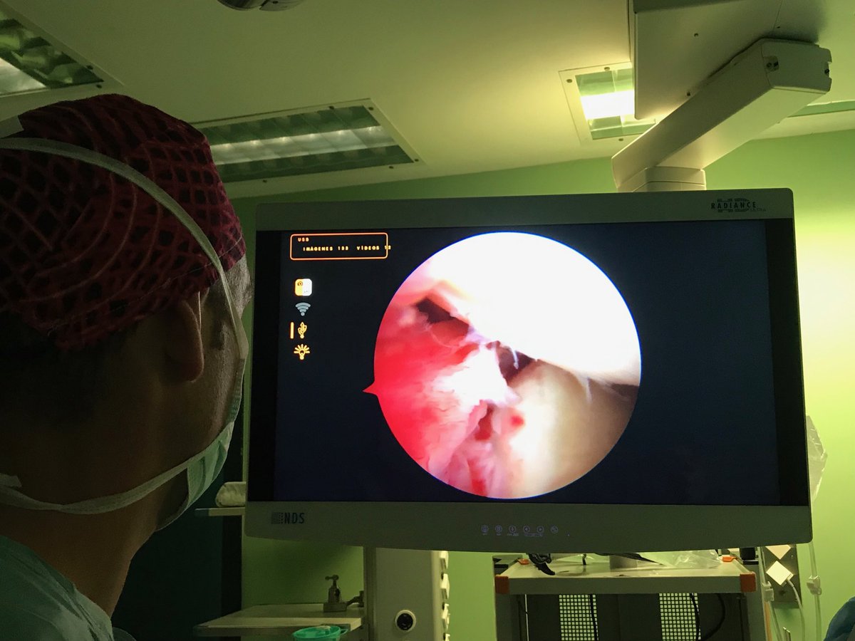 CrespoRiveroJo1's tweet photo. #Artroscopia de hombro, con reparación de #inestabilidad por lesión de labrum anterior. Acompañado de la ⁦@MartosDra⁩ #hospiten #cirugia #suturefix #shoulderartrhroscopy https://t.co/oloCW7aqjx