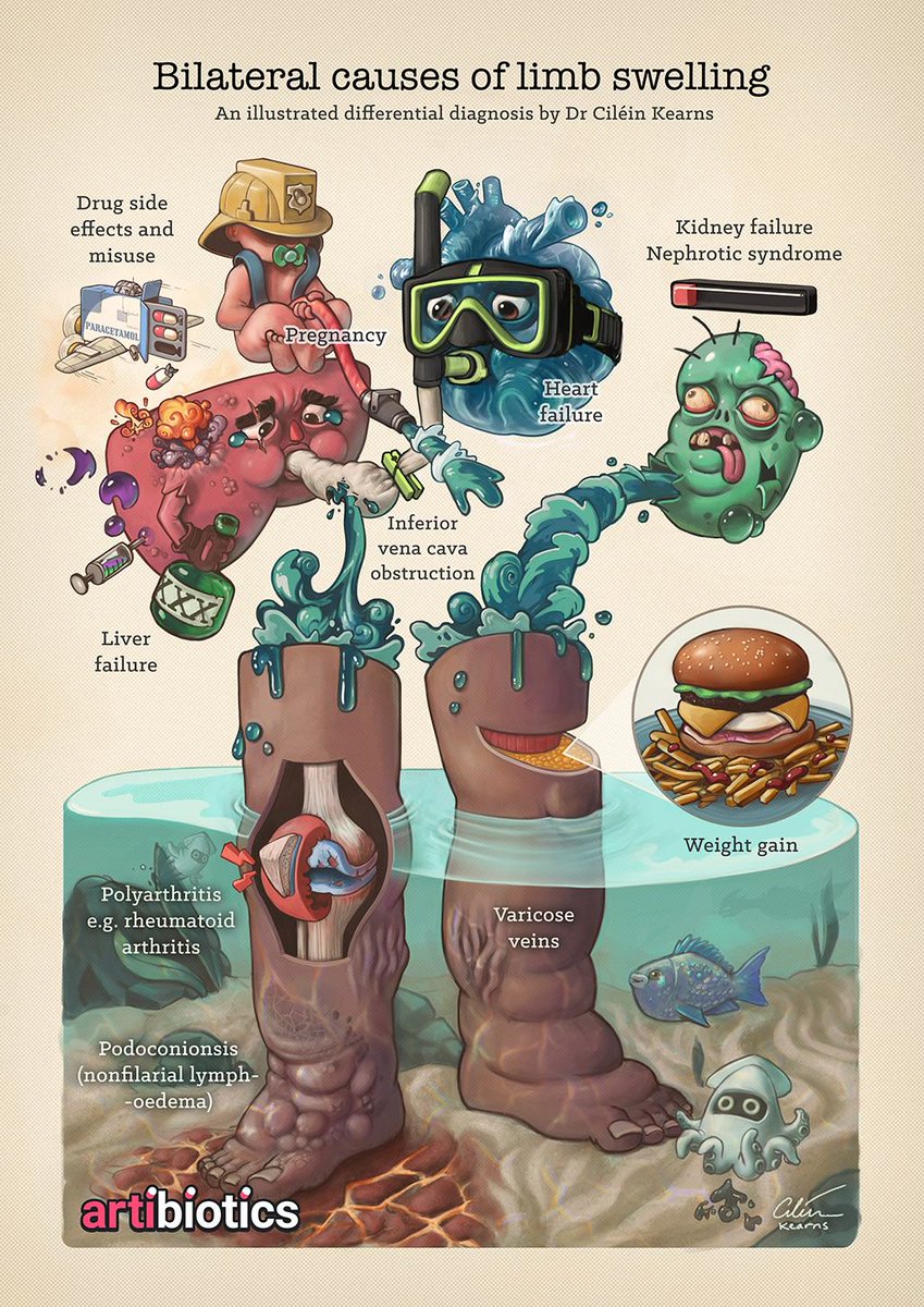 artibiotics's tweet photo. Causes of bilateral limb swelling, an illustrated differential diagnosis! If you'd like to support me illustrating medicine, consider a coffee membership to the Scrub Club on Patreon (https://t.co/oo9crh9w1X) https://t.co/vP4yWPmLtO