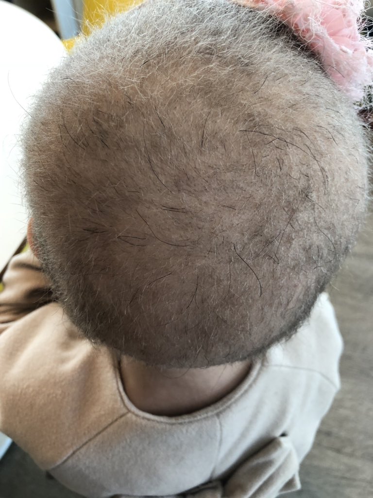 Daniel Lozeau Md On Twitter School Aged Child With Fine Light
