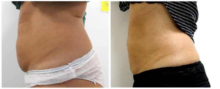 skinfinityleeds's tweet photo. Amazing before and after results from our Smartlipo procedure. 

Laser technology is used to melt away unwanted fat, the advantages are;
​
- Quick procedure
- Local anaesthetic
- Fast recovery
- Safe
- Long-lasting results

 https://t.co/a0RtR3caQ0 

0113 397 0980 https://t.co/kx3gt81X89