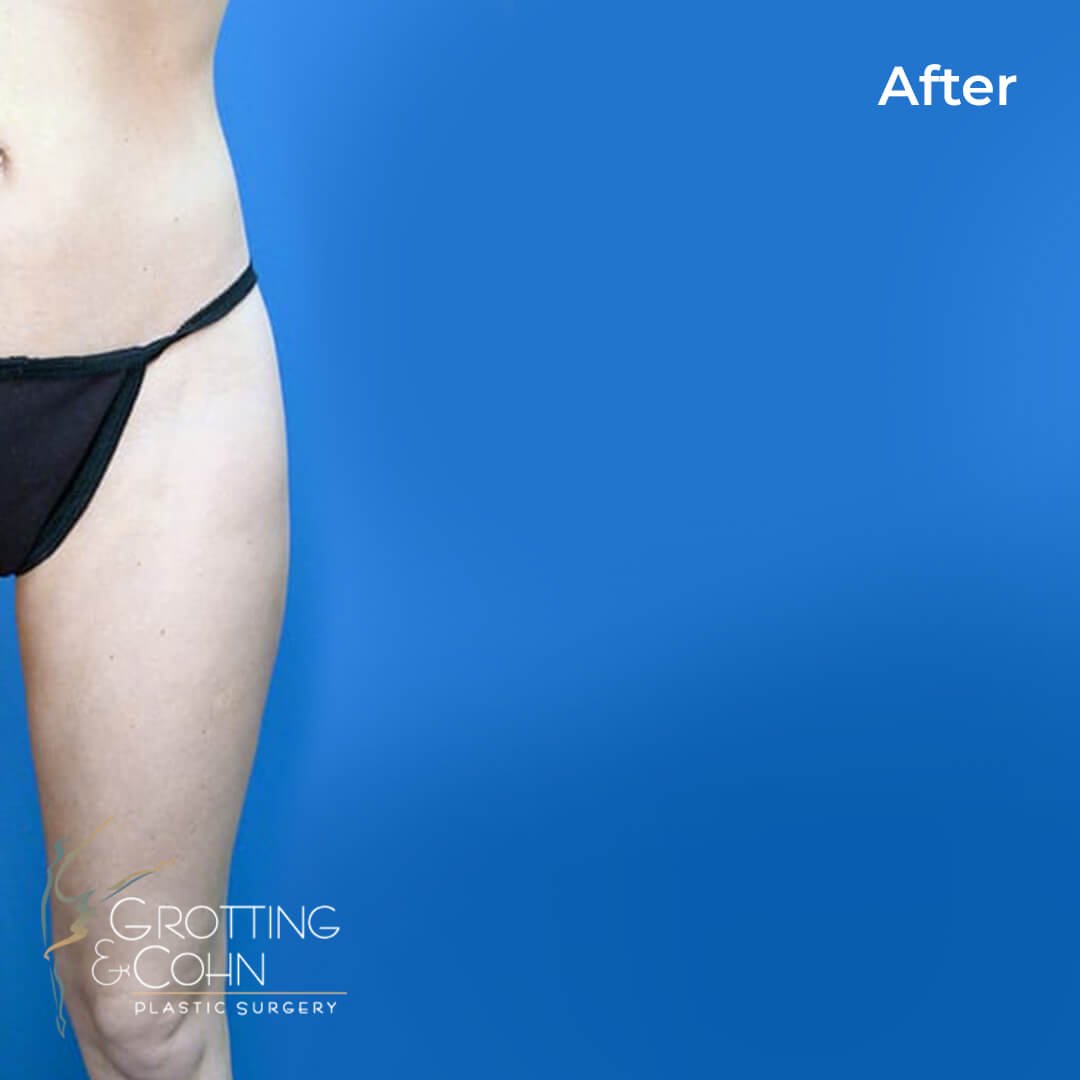 types of liposuction types of liposuction