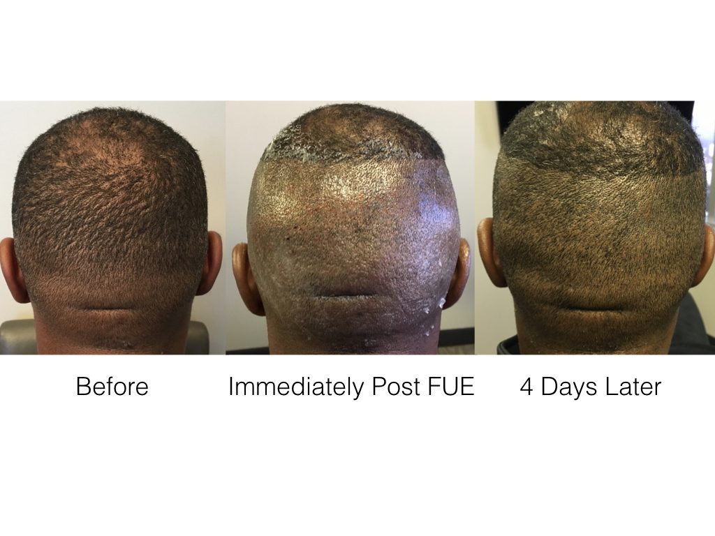 Dauerhairrestoration Marcdauermd Twitter