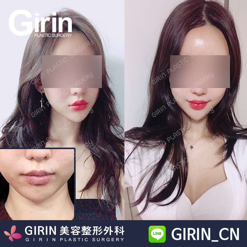 girinjp's tweet image. ヒアルロン酸注入で自然と口角が上がり、可愛くてふっくら唇へ～♡♡♡

● 口角1㏄：16万ウォン
● 唇1㏄：16万ウォン
● 口角唇フィラー（容量無制限）：37万ウォン

☆☆ 容量無制限でお得なイベント☆☆

#可愛くなりたい　#ふっくら唇　#口角💋#韓国美容　#カンナム整形外科　#韓国グルメ