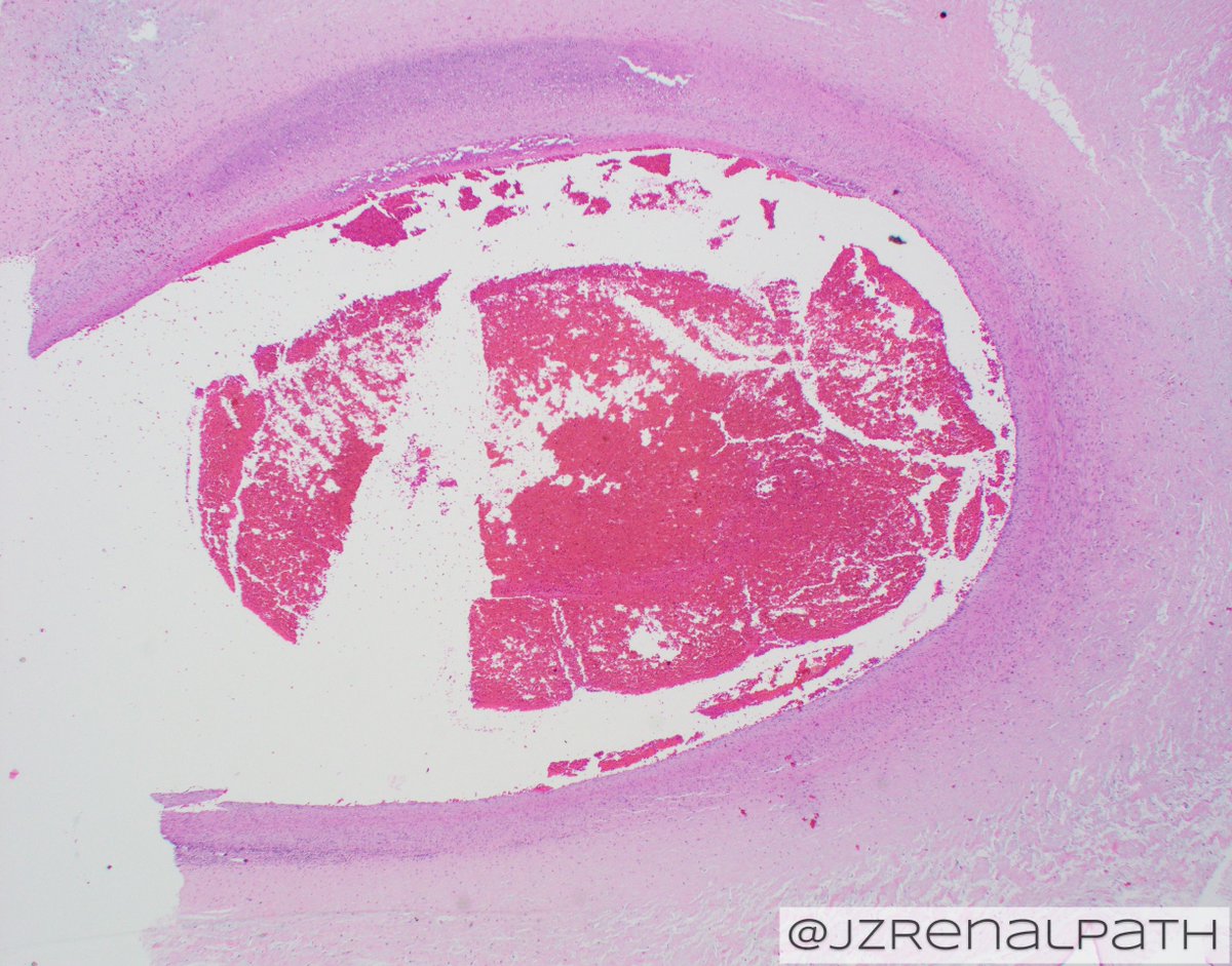JZRenalPath's tweet photo. Amazing case of congenital syphilis in a placenta. Necrotizing funisitis with calcification. Spirochete IHC shown. Syphilis is on the rise, keep it in mind for your DDx.  #pathology #placentalpathology https://t.co/KztBjjiwAC
