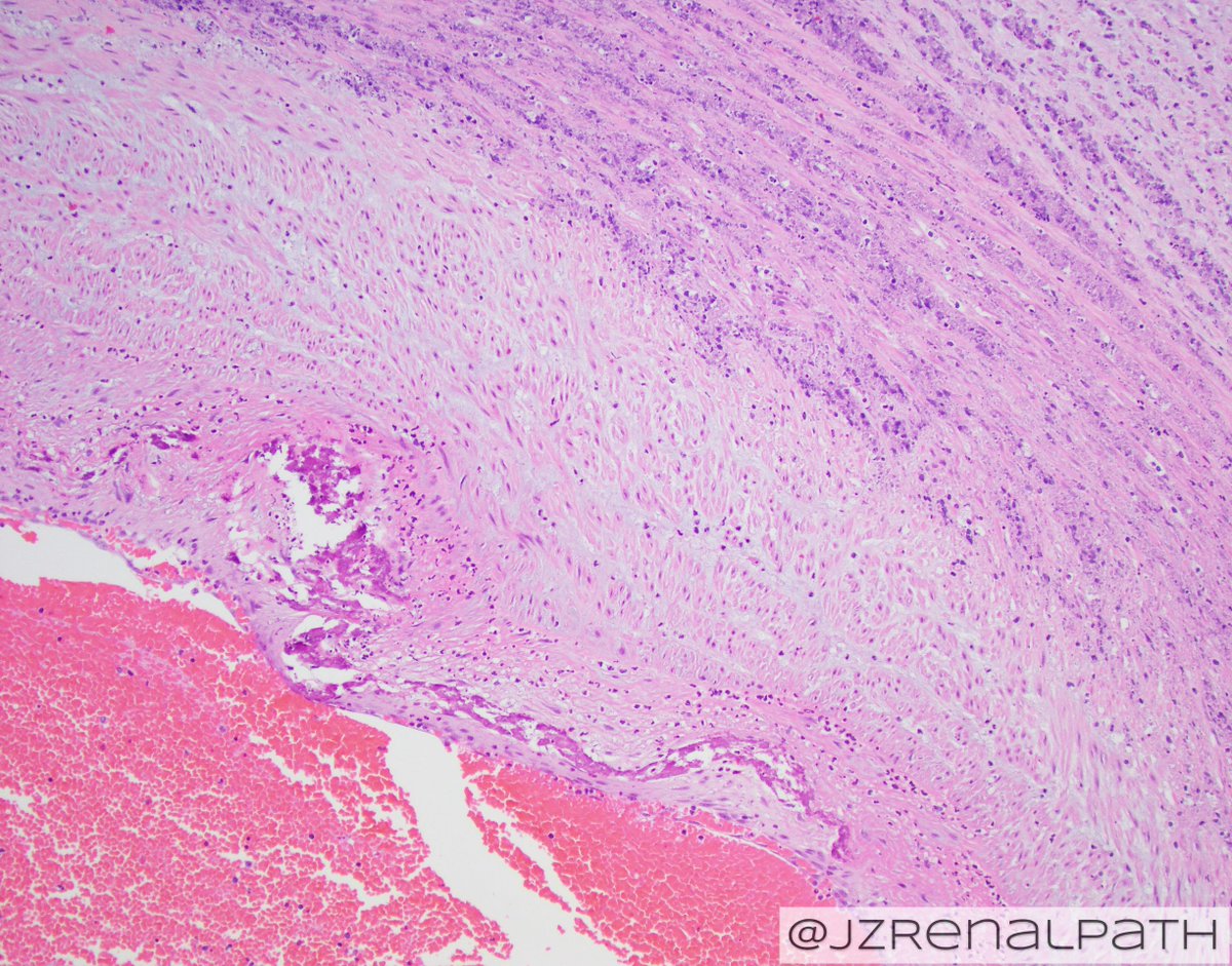 JZRenalPath's tweet photo. Amazing case of congenital syphilis in a placenta. Necrotizing funisitis with calcification. Spirochete IHC shown. Syphilis is on the rise, keep it in mind for your DDx.  #pathology #placentalpathology https://t.co/KztBjjiwAC