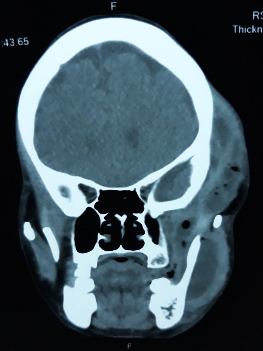 ghieislami's tweet photo. Abses regio maxilla sx. S/d temporalis sx yg mengenai musculus temporalis et masseter sx, disertai gambaran sinusitis maxillaris sx (minimal).
#Askdokter https://t.co/BpJIT2xle4