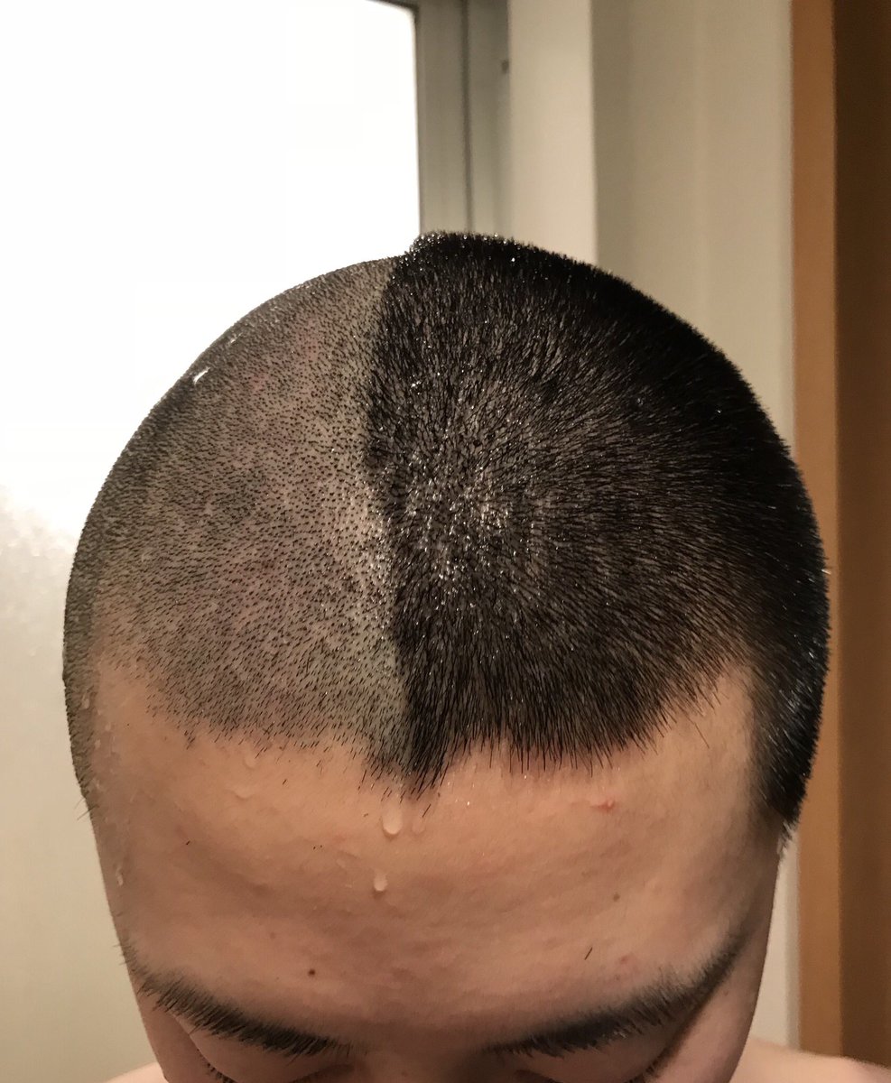 皐牙 1週間と少し伸びた坊主とこれだけ差が出るんだなって T Co Qy7zysujk8 Twitter 皐牙 1週間と少し伸びた坊主とこれだけ差が出るんだなって T Co Qy7zysujk8 Twitter