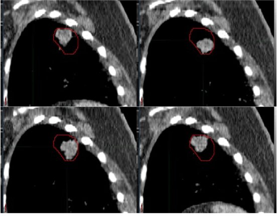 omicsrad's tweet image. #Radiology #LungCancerMotionManagement #SubmissionOpen
The field of radiation oncology has entertained either side-byside computing technology, overlay of diagnostic and planning image sets, or fusion of positron emission tomography (PET)....
Contact: radiology@emedsciences.com