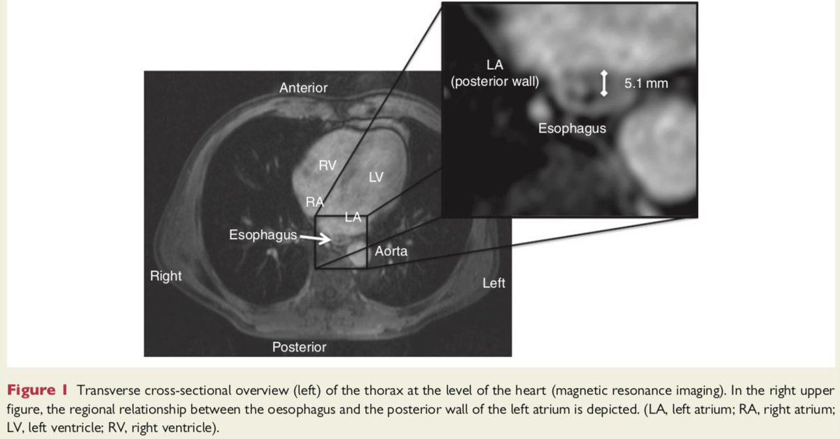 Dominik_Linz's tweet photo. @drsuneet Very interesting case!-> #Roemheld syndrome (gastric-cardia)?! Even very small hiatus hernias may cause these symptoms (MRI/CT?). Maybe try to block it by atropine (no treatment but Proof-of-Concept). See also our recent review in #EUROPACE https://t.co/7ZuYdnnxlA @ESC_Journals https://t.co/K1kZ07pk9u