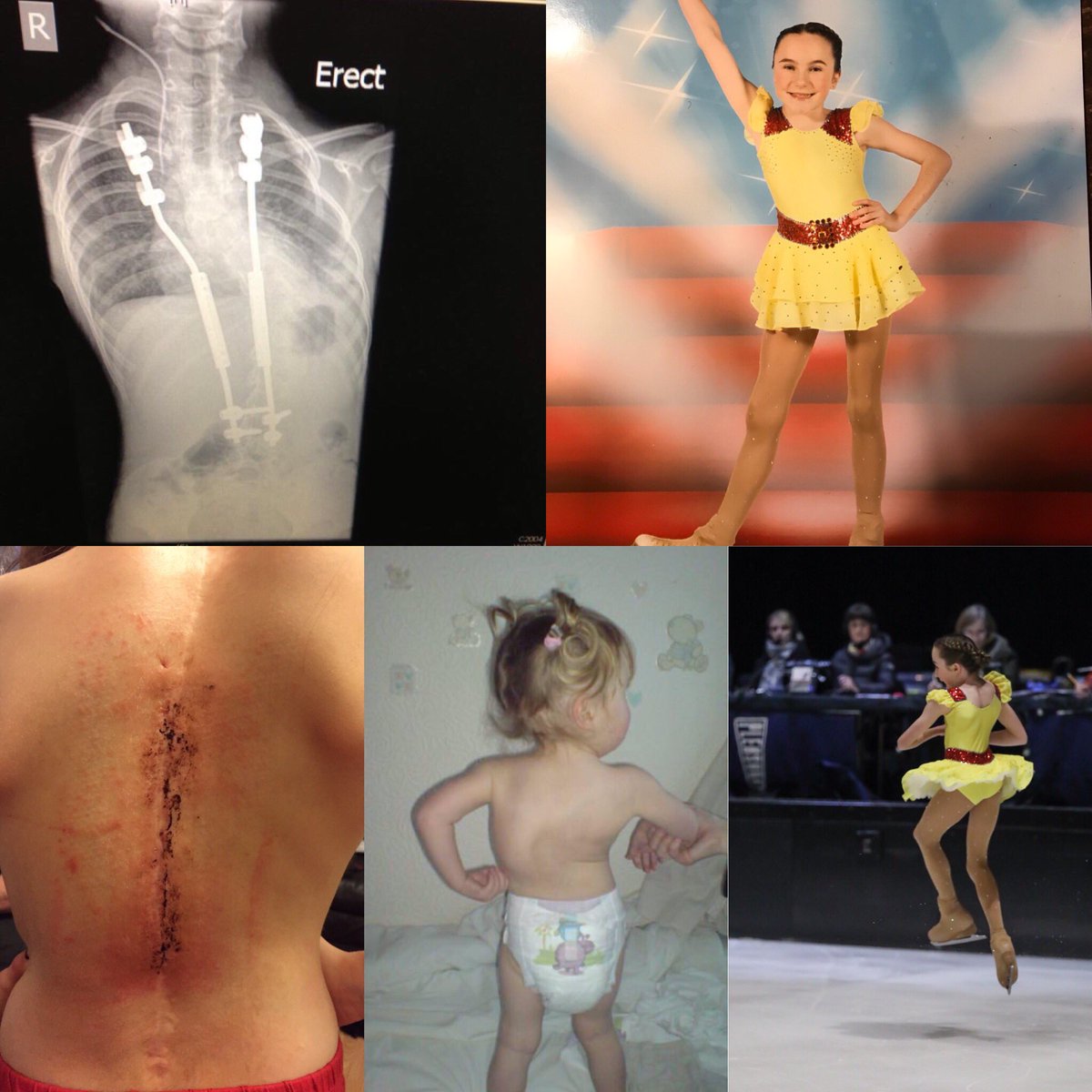 ktstainsby's tweet photo. This is our incredible student Megan Shorrock, she has been shortlisted to be an ambassador for @twobirdslondon please check her story out and give her a vote here https://t.co/YpyBxiU5E9 #scoliosisawareness #iceskater #incredibe https://t.co/KWrRUSxeCW