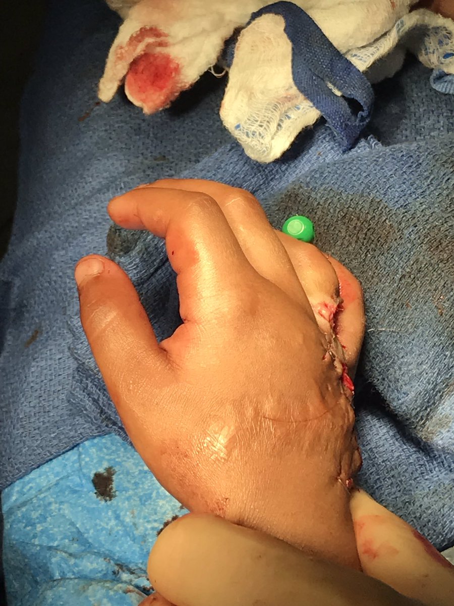 Thanks to Wishbone Foundation #WBOFonmission <a href="/WishBoneOF/">WishBone Orthopaedic Foundation</a> for providing the self contained k-wire kit to help this 4 yo child who had a contracture after an infection.  Children of the nations in the Dominican Republic #COTNI <a href="/COTNI/">ChildrenOfTheNations</a>