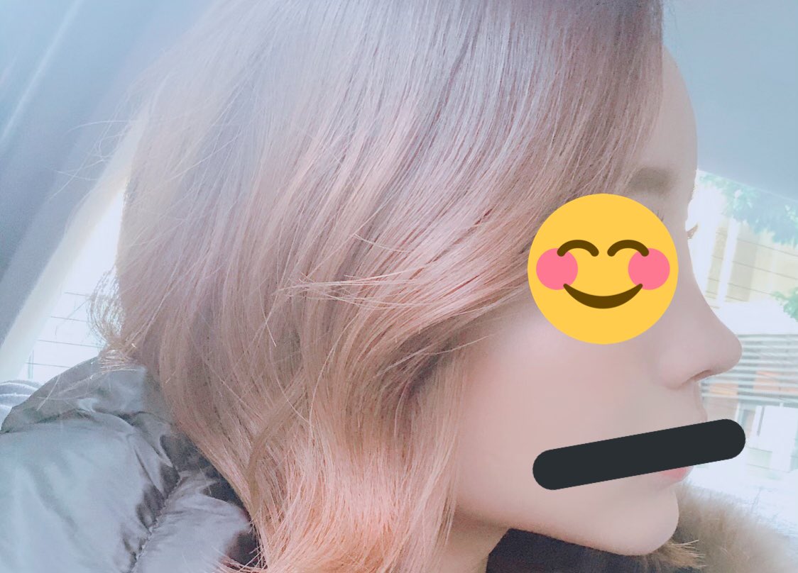 reika4618's tweet photo. Sウルリスタ、術後１ヶ月。この時の鼻が一番好き。今月で術後4ヶ月🤘🏻
年内には輪郭したいけどな〜。
仕事頑張るかぁ😨 https://t.co/msBr7NGKxh