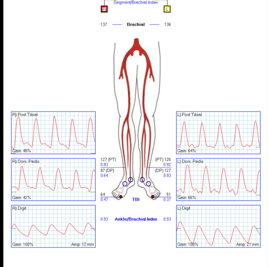 jmills1955's tweet photo. Incorporate @VascularSVS #WIfI into your #CLTI workflow. Every patient with #DFU should have perfusion measurements. It is no longer acceptable to fail to assess for ischemia. #LimbSalvage #ComprehensiveVascularCare @BEST_CLI @basil_trials @iwgdf @monteromiguel @diabeticfoot1 https://t.co/xriNe80l5I