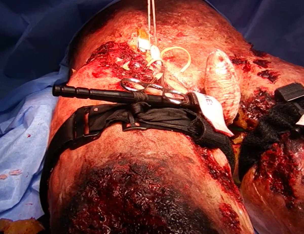 Junctional haemorrhage control at the groin demonstrated on SAM-1 Massive Blast Injury model at the Major Incident Surgical &amp; Trauma Teams Course. Choose Supra-, trans-, or infra-inguinal approaches. Find out via enquiries@traumasimulation.co.uk  <a href="/MISTTCourse/">MISTT Course</a>