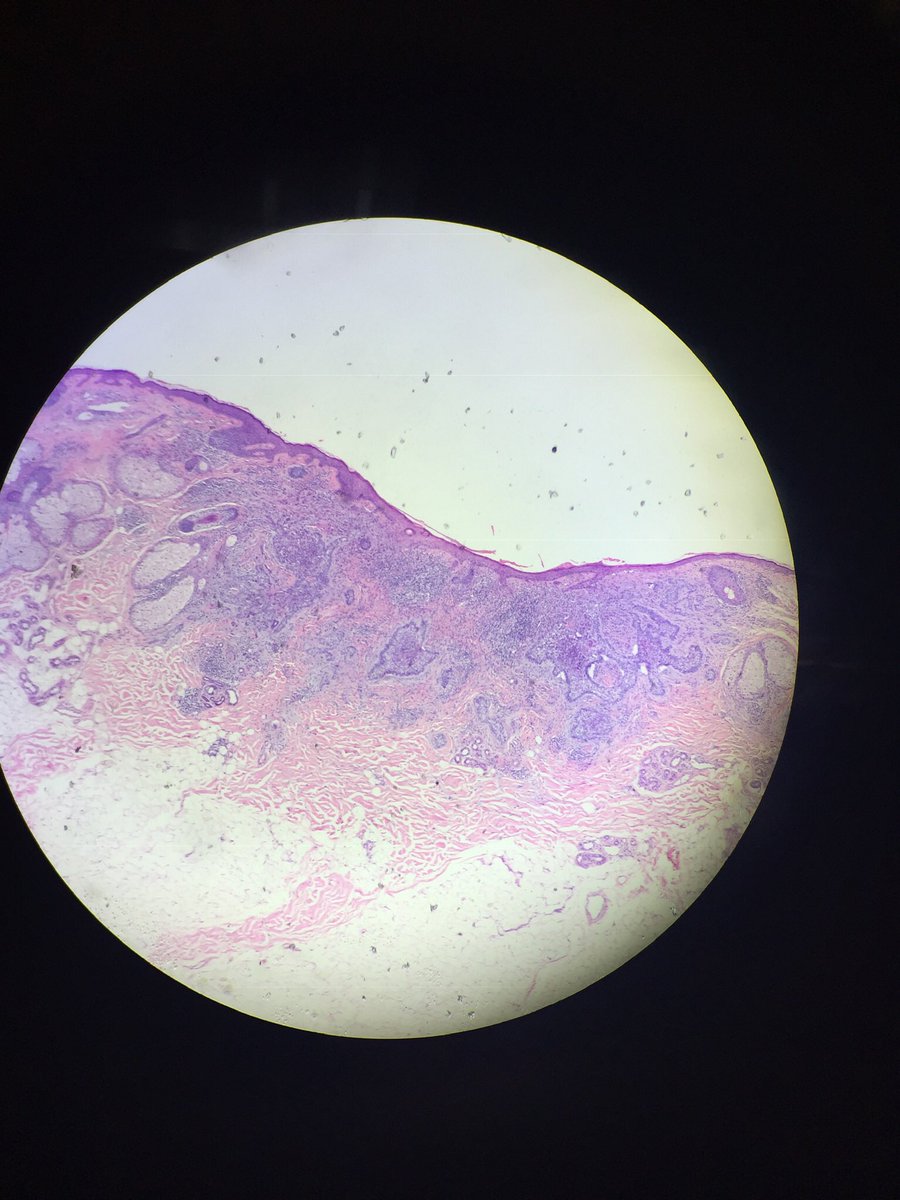 FialaSinclare's tweet photo. @HobbsLabUNK This is a picture of the skin cancer basal cells we were observing in lab this week. We learned in class that cancer is most often caused by defective or deficient Rb or p53 proteins. #106Week9NHS19 https://t.co/2leRo5NDsk