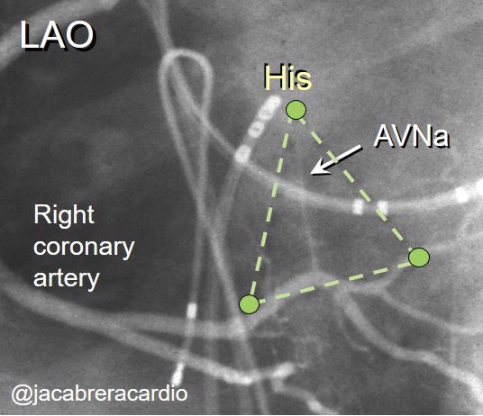 Folowing with your patient <a href="/CarinaHardy4/">CarinaHardyEP</a> <a href="/crpisani/">Cristiano Pisani</a> The images shows RCA &amp; CS relation in the 🔹right inferior paraseptal region 🔹<a href="/Dr_Santangeli/">Pasquale Santangeli</a> <a href="/LuigiDiBiaseMD/">Luigi Di Biase</a> <a href="/adribaran/">Adrian Baranchuk MD FACC FRCPC FCCS FSIAC</a> <a href="/aalahmadmd/">Amin Al-Ahmad, MD</a> <a href="/MuhieddineC/">muhieddine chokr</a> <a href="/Scanav1Mauricio/">Mauricio Scanavacca</a> <a href="/MDTolgaAksu/">Tolga Aksu, MD</a> <a href="/ALFIEEP1/">ALBERTO ALFIE</a> <a href="/DrAJRestrepo/">Alejandro Jimenez Restrepo</a> <a href="/DoctorPhillEP/">Phillip Cuculich, MD</a> <a href="/drluissaenz/">Luis C. Saenz, MD</a>