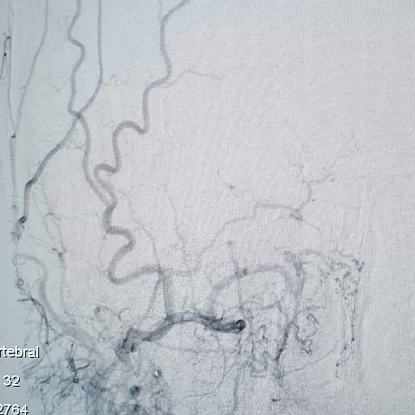 Akut Total İCA okluzyonu olan hastada aspirasyonu ve stent trombektomi ile tam açılma sağlandı. İşlemden sonra hastanın nörolojik bulguları geriledi ve 1 hafta sonra taburcu oldu. #radyoloji #tıbbigörüntüleme